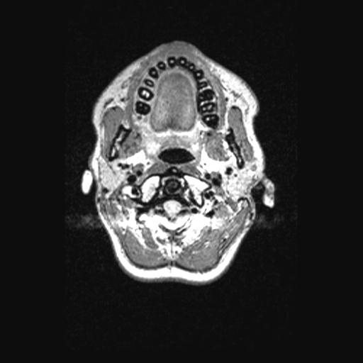 Atretic encephalocoele with inferior vermis hypoplasia (Radiopaedia 30443-31108 Axial 12).jpg