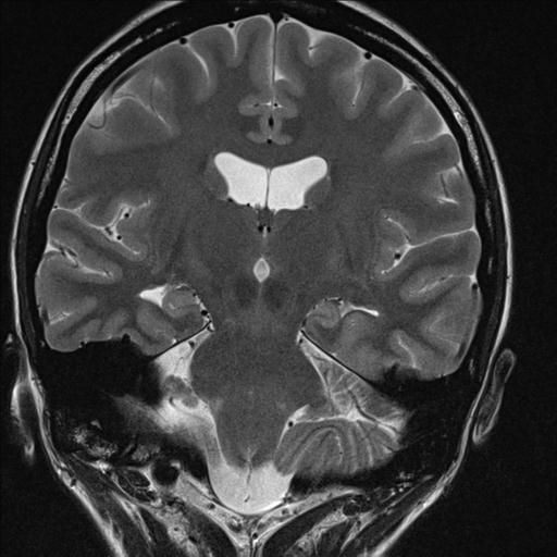 File:Atretic encephalocoele with inferior vermis hypoplasia (Radiopaedia 30443-31108 Coronal T2 5).jpg