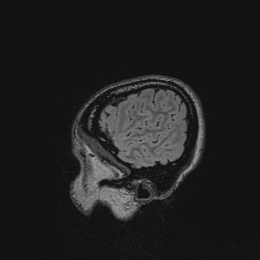 Atretic encephalocoele with inferior vermis hypoplasia (Radiopaedia 30443-31108 Sagittal FLAIR 28).jpg