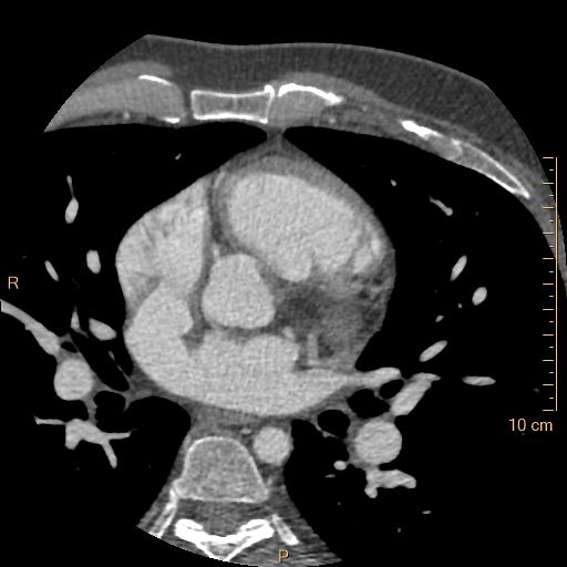 Atrial septal defect (upper sinus venosus type) with partial anomalous pulmonary venous return into superior vena cava (Radiopaedia 73228-83961 A 104).jpg