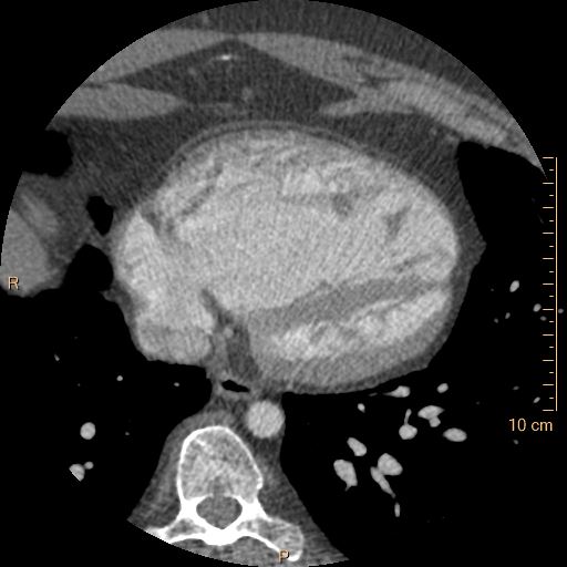 Atrial septal defect (upper sinus venosus type) with partial anomalous pulmonary venous return into superior vena cava (Radiopaedia 73228-83961 A 208).jpg