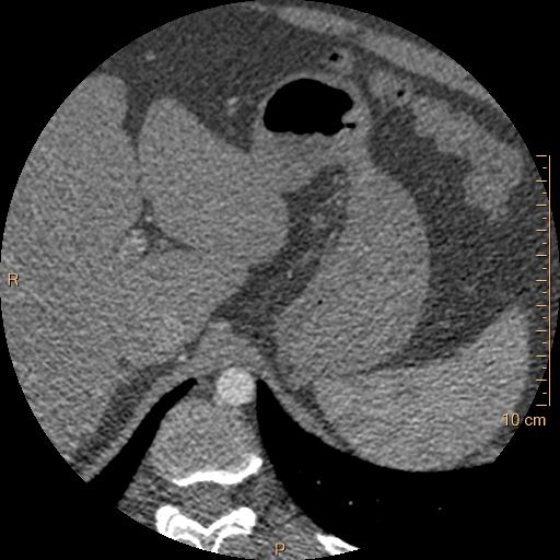 File:Atrial septal defect (upper sinus venosus type) with partial anomalous pulmonary venous return into superior vena cava (Radiopaedia 73228-83961 A 316).jpg