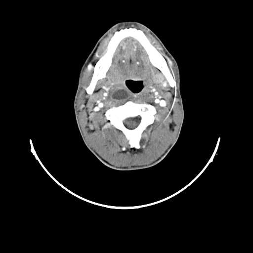 File:Atypical 2nd branchial cleft cyst (type IV) - infected (Radiopaedia 20986-20924 A 10).jpg