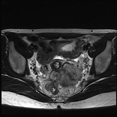 File:Atypical deep infiltrating endometriosis (Radiopaedia 44470-48125 Axial T2 16).jpg