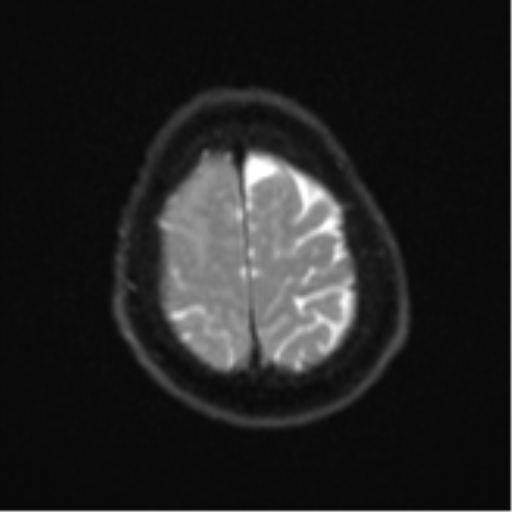 Atypical meningioma (WHO Grade II) (Radiopaedia 54742-60979 Axial DWI 24).png