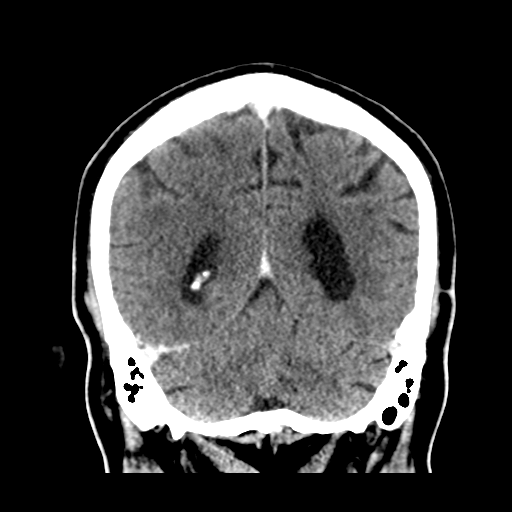 Atypical meningioma (WHO grade II) with brain invasion (Radiopaedia 57767-64728 Coronal C+ 46).png