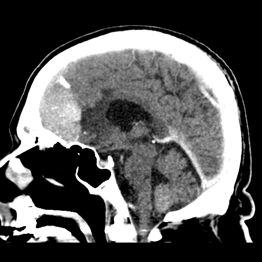 Atypical meningioma (WHO grade II) with brain invasion (Radiopaedia 57767-64728 Sagittal C+ 25).png