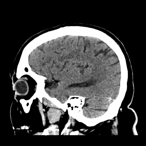 Atypical meningioma (WHO grade II) with brain invasion (Radiopaedia 57767-64728 Sagittal C+ 39).png