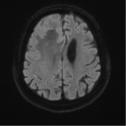 File:Atypical meningioma (WHO grade II) with brain invasion (Radiopaedia 57767-64729 Axial DWI 51).png