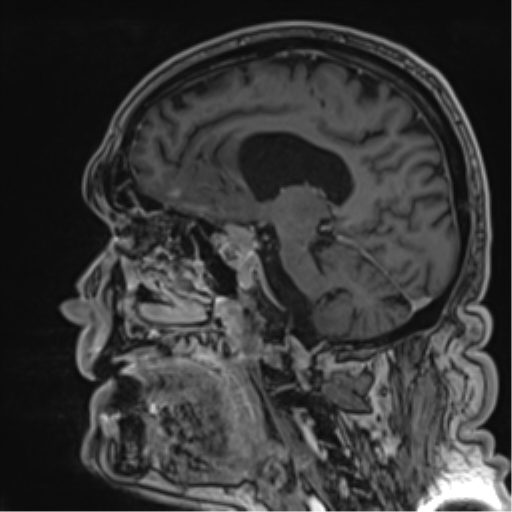 Atypical meningioma (WHO grade II) with brain invasion (Radiopaedia 57767-64729 Sagittal T1 C+ 32).png