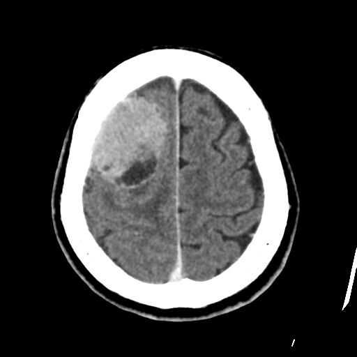 Atypical meningioma with skull invasion (Radiopaedia 34357-35649 Axial C+ delayed 43).png