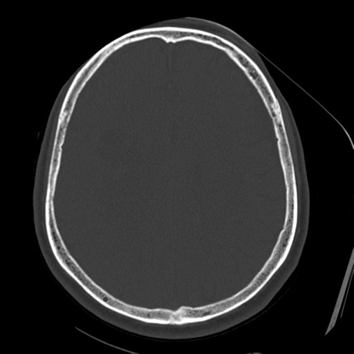 Atypical meningioma with skull invasion (Radiopaedia 34357-35649 Axial bone window 54).png