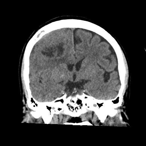 Atypical meningioma with skull invasion (Radiopaedia 34357-35649 Coronal non-contrast 31).png