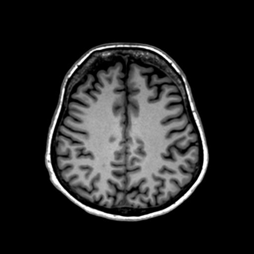 Autoimmune limbic encephalitis (Radiopaedia 30363-31005 T1 Axial 1mm 106).jpg