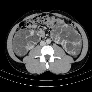 Autosomal dominant polycystic kidney disease (Radiopaedia 66349-75582 B 55).jpg