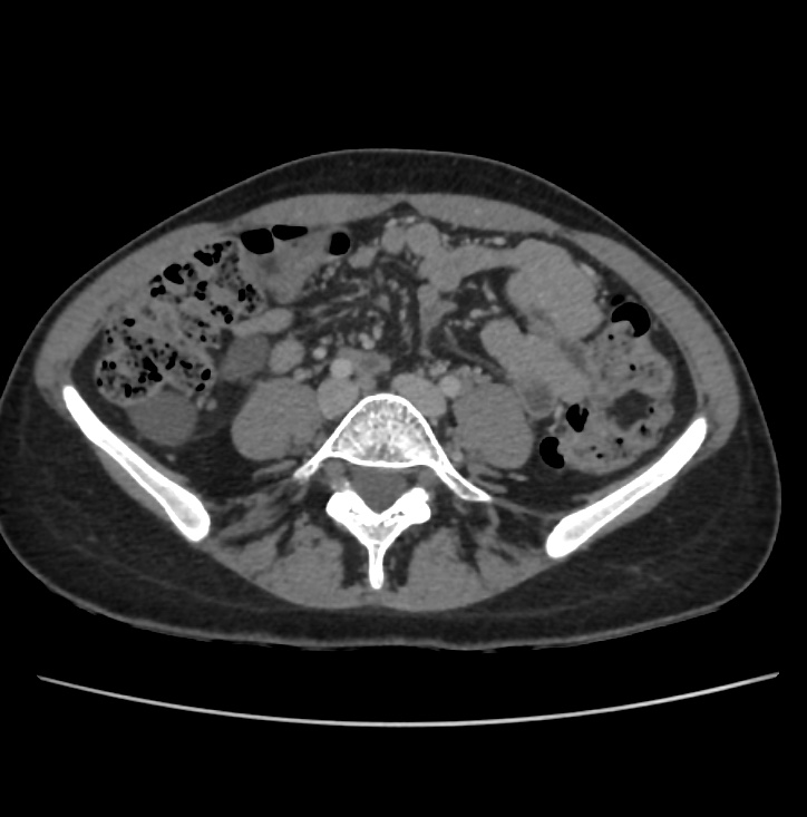 Autosomal dominant polycystic kidney disease - early onset (Radiopaedia 40734-43387 A 56).jpg