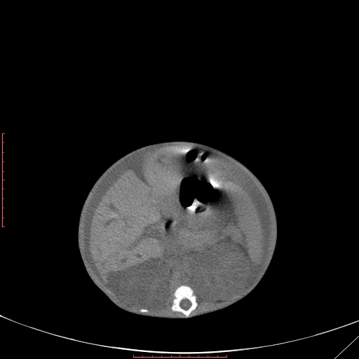 Autosomal recessive polycystic kidney disease associated with Caroli disease (Radiopaedia 61932-69984 Axial non-contrast 175).jpg
