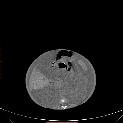 Autosomal recessive polycystic kidney disease associated with Caroli disease (Radiopaedia 61932-69984 Axial non-contrast 204).jpg
