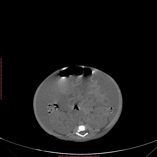 Autosomal recessive polycystic kidney disease associated with Caroli disease (Radiopaedia 61932-69984 B 241).jpg
