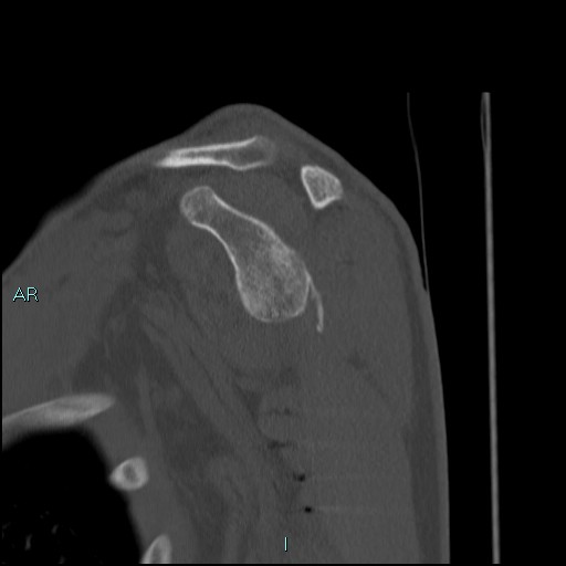 File:Avascular necrosis after fracture dislocations of the proximal humerus (Radiopaedia 88078-104653 Sagittal bone window 37).jpg