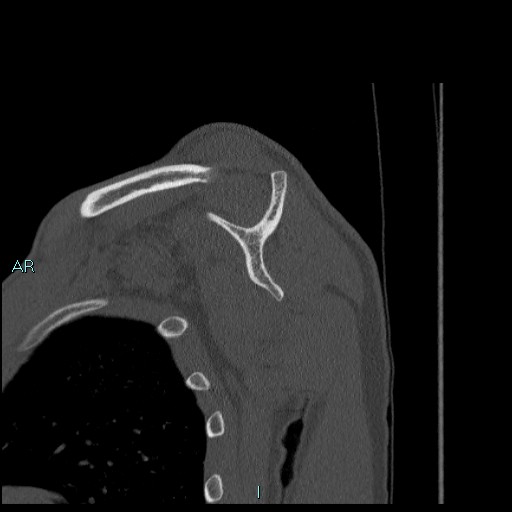 Avascular necrosis after fracture dislocations of the proximal humerus (Radiopaedia 88078-104655 Sagittal bone window 41).jpg