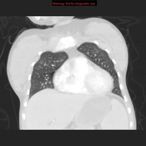 File:Avascular necrosis in sickle cell disease (Radiopaedia 17448-17152 B 35).jpg