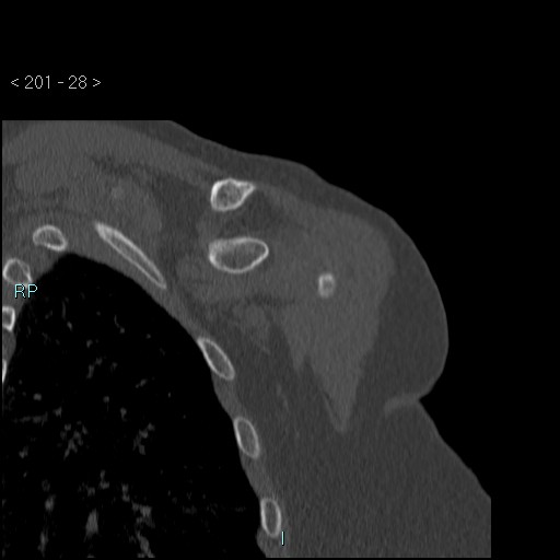Avascular necrosis of the shoulder - Cruess stage I (Radiopaedia 77674-89887 Coronal bone window 27).jpg