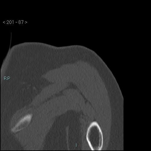 Avascular necrosis of the shoulder - Cruess stage I (Radiopaedia 77674-89887 Coronal bone window 86).jpg