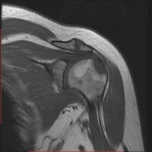 File:Avulsion fracture - greater tuberosity of humerus (Radiopaedia 25457-25703 Coronal T1 6).jpg
