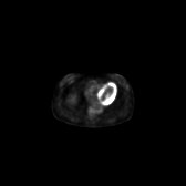 B-cell lymphoma of the mesentery (Radiopaedia 65743-74868 18F-FDG PET-CT 188).jpg