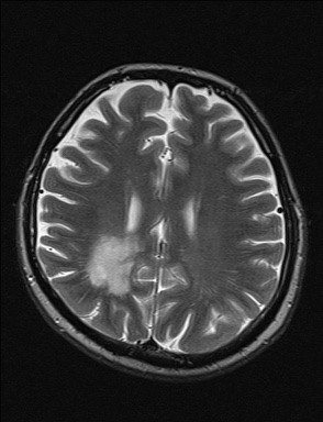 File:Balo concentric sclerosis (Radiopaedia 50458-55940 Axial T2 15).jpg
