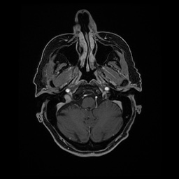 Balo concentric sclerosis (Radiopaedia 53875-59982 Axial LAVA C+ 52).jpg