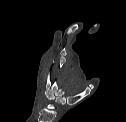 Base of 2nd metacarpal fracture (Radiopaedia 73741-84544 Coronal bone window 54).jpg