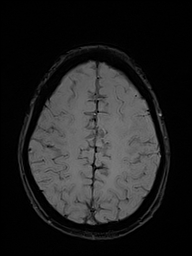 Basilar artery perforator aneurysm (Radiopaedia 82455-97733 Axial SWI 46).jpg