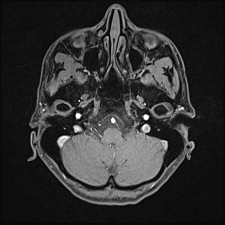 Basilar artery perforator aneurysm (Radiopaedia 82455-97733 Axial T1 fat sat 24).jpg