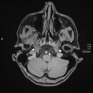 Basilar artery perforator aneurysm (Radiopaedia 82455-99523 F 10).jpg
