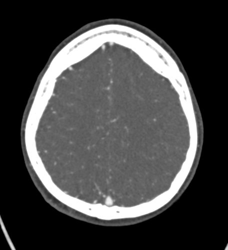 Basilar tip aneurysm with coiling (Radiopaedia 53912-60086 A 115).jpg
