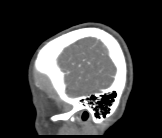 Basilar tip aneurysm with coiling (Radiopaedia 53912-60086 C 125).jpg