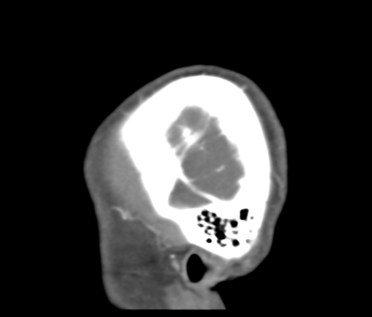 Basilar tip aneurysm with coiling (Radiopaedia 53912-60086 C 131).jpg