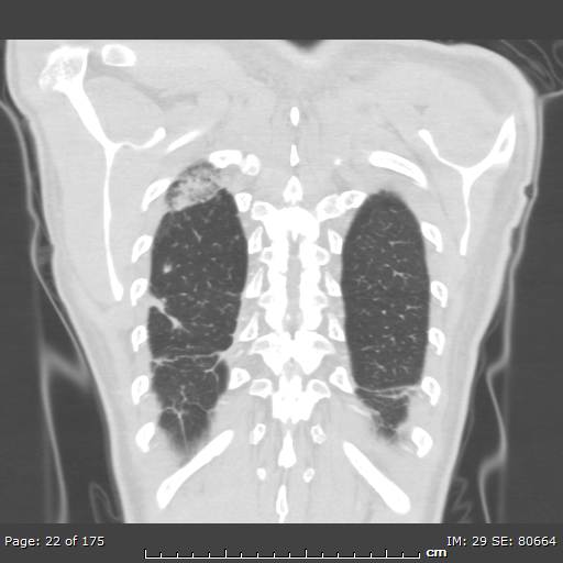 Behçet disease (Radiopaedia 44247-47889 Coronal lung window 2).jpg
