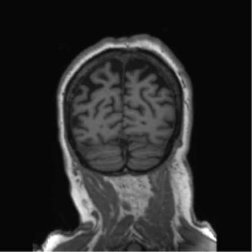 Behavioral variant frontotemporal dementia and late onset schizophrenia (Radiopaedia 52197-58083 Coronal T1 23).png