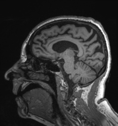 Behavioral variant frontotemporal dementia and late onset schizophrenia (Radiopaedia 52197-58083 Sagittal T1 41).png
