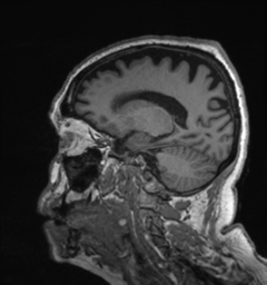 File:Behavioral variant frontotemporal dementia and late onset schizophrenia (Radiopaedia 52197-58083 Sagittal T1 66).png