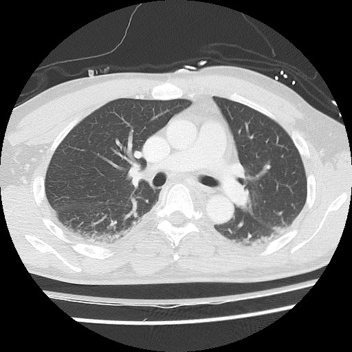 Benign post-traumatic pseudopneumoperitoneum (Radiopaedia 71199-81495 Axial lung window 34).jpg