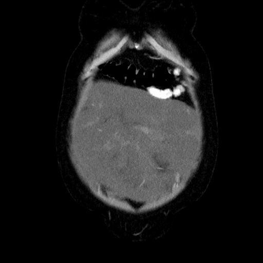 File:Benign spindle cell tumor - abdominopelvic (Radiopaedia 61300-69212 C 11).jpg