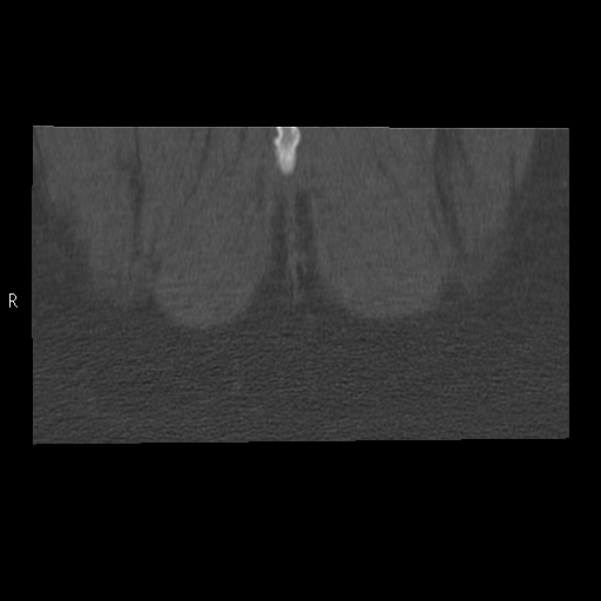 Bertolotti syndrome (Radiopaedia 24864-25128 Coronal bone window 60).jpg