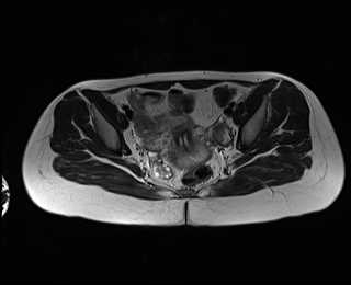 File:Bicornuate bicollis uterus (Radiopaedia 61626-69616 Axial T2 20).jpg
