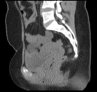 File:Bicornuate uterus (MRI) (Radiopaedia 49206-54296 Sagittal 1).png
