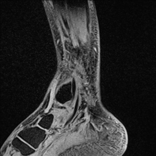 Bilateral Achilles tendon complete tear (Radiopaedia 81344-95051 Sagittal WE - Left 33).jpg