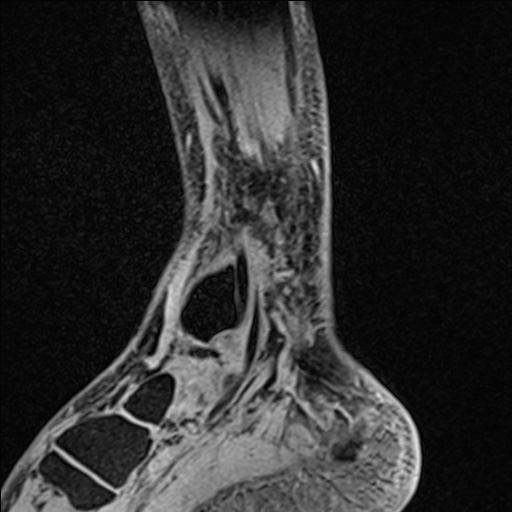File:Bilateral Achilles tendon complete tear (Radiopaedia 81344-95051 Sagittal WE - Left 34).jpg